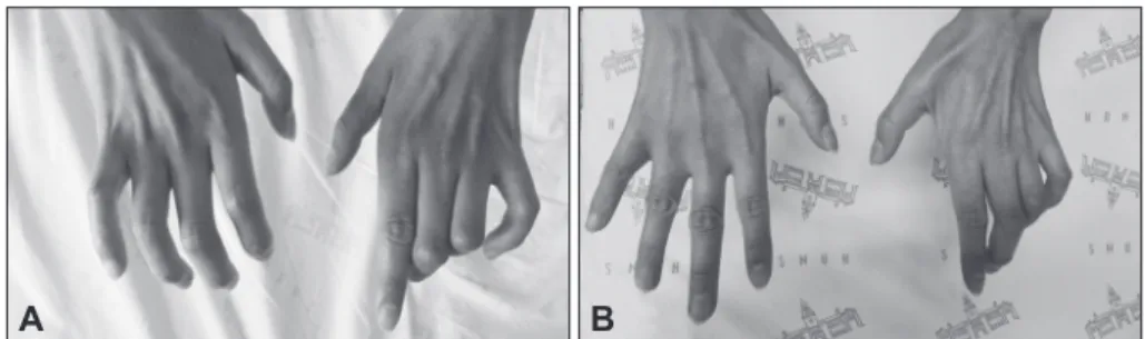 Fig. 1. Deformities of both hands in our  patient. Severe deformities in the right  hand (A) were much improved (B) after  treatment with high-dose intravenous  immunoglobulin (0.4 g/kg/day) for 5  con-secutive days.