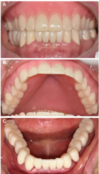 Fig. 3. Interim prostheses. (A) Frontal view, (B) Occlusal view of maxilla, (C) Occlusal view of mandible.