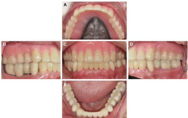 Fig. 10. Postoperative extraoral photograph &amp; panoramic view. (A) Frontal view, (B) Lateral view