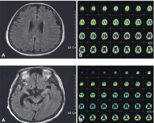 Fig. 1. A: Brain magnetic resonance im- im-aging shows diffuse brain atrophy on  flu-id-attenuated inversion recovery   imag-es