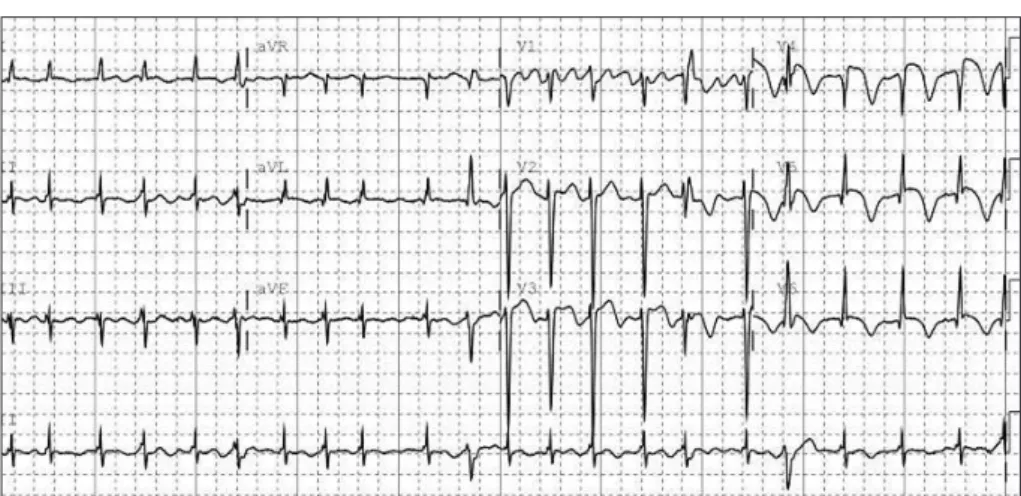 Fig. 2. Electrocardiography showing atrial fibrillation with ST-segment elevation at leads I, aVL, and V2-5, suggesting acute anterolateral  wall ischemia.