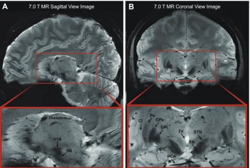 Fig. 1. Sagittal (A) and coronal (B) images obtained by 7.0 T MRI using a brain-optimized sensitivity encoding coil