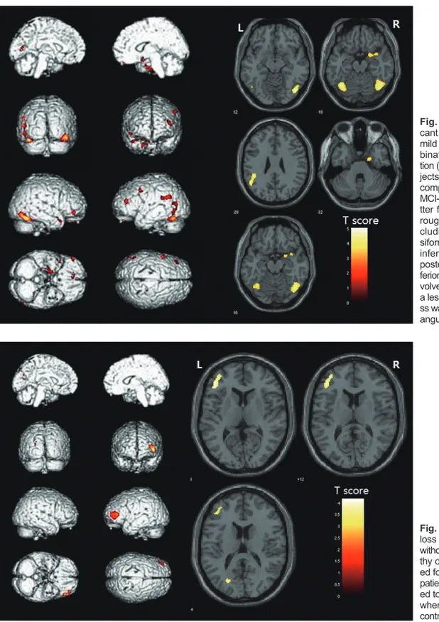 Fig. 1. Patterns of statistically signifi- signifi-cant loss of gray matter in patients with  mild cognitive impairment (MCI) in  com-bination with topographical  disorienta-tion (TD) compared to healthy control  sub-jects (p&lt;0.001, uncorrected for mult