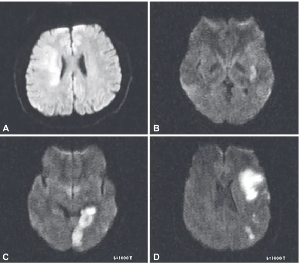 Fig. 1. Diffusion-weighted MRI in four pa- pa-tients. A: Case 1 had infarcts in the  distri-bution of the right middle cerebral artery