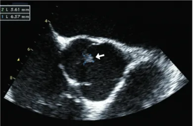 Fig. 3. Transesophageal echocardiogram in case 4. A small mov- mov-able mass can be seen attached to aortic valve (arrow)