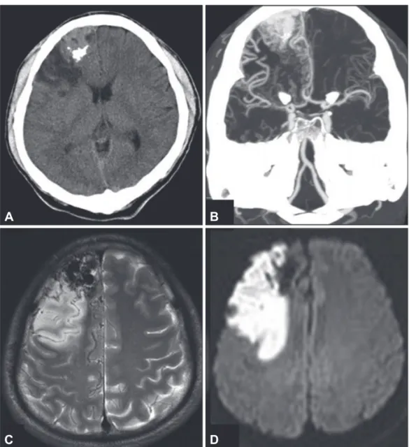 Fig. 1. Results of brain computed tomo- tomo-graphy (CT) and magnetic resonance  im-aging (MRI)