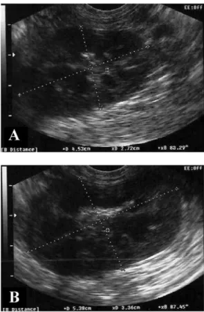 Fig. 5.  Sagittal sonogram of the kidney ([A] right kidney, [B] left kidney). It shows bilateral mild nephromegaly.