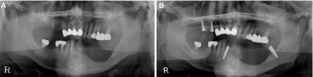 Fig. 3. Radiograph after (A) extraction and (B) implant surgery.