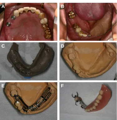 Fig. 5. Try in. #38 area is convex protruding form due to lack of space.
