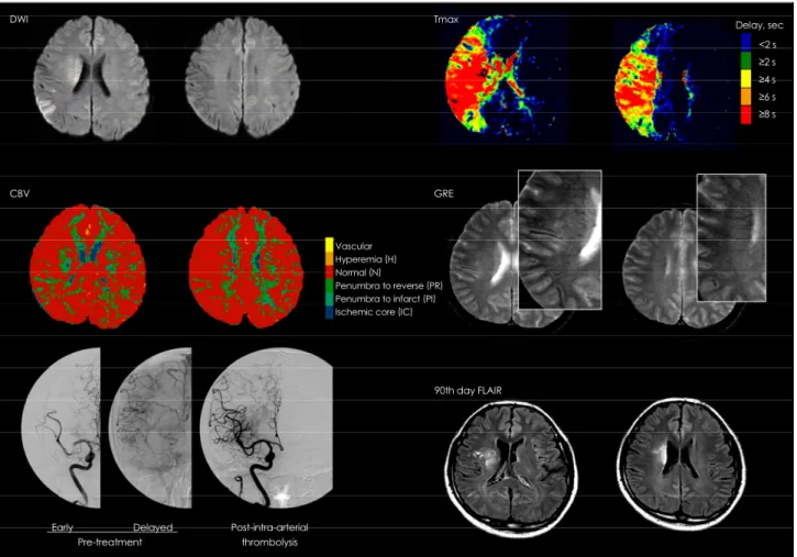 Fig. 2 shows a case with prominent hypointense lepto- lepto-meningeal vessels. Although mismatch areas showed an  ex-tensive, severe delay in time-dependent PWI [time to peak  after deconvolution (T max ) delayed by 8 s or more],  suggest-ing an ischemic c