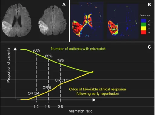 Fig. 3. DWI (A) and PWI (B) findings of  a patient who exhibited the no-match  pattern  (a PWI volume <120% of the DWI lesion volume)