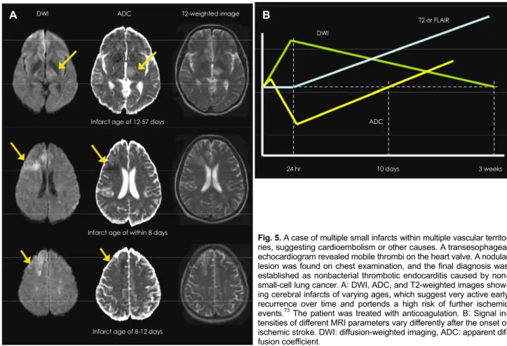 Fig. 5. A case of multiple small infarcts within multiple vascular territo- territo-ries, suggesting cardioembolism or other causes