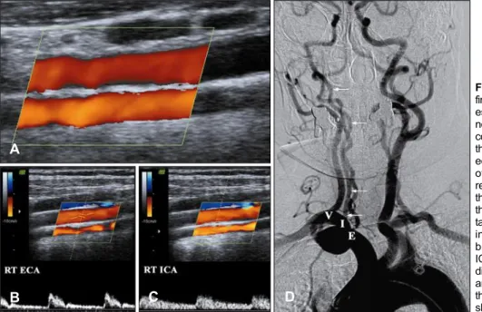 Fig. 1. Sonographic and angiographic findings of common carofid artery  agen-esis.  (A) Color-coded duplex  ultraso-nography showing absence of the right common carotid artery (CCA)
