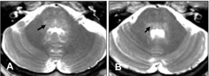 Fig. 1.  T2-weighted magnetic resonance images showing bilat- bilat-eral symmetric hyperintense lesions in the pontine tegmentum