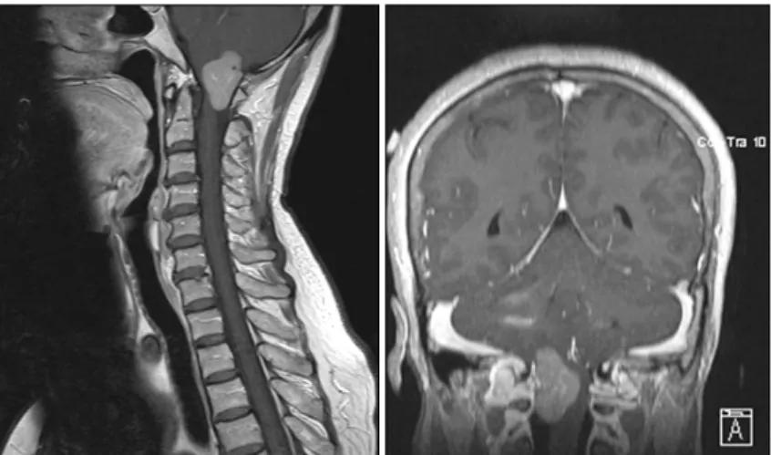 Fig. 1. MRI of the cervical spine with gadolinium enhan- enhan-cement revealed a well-defined gadolinium-enhanced mass at the craniocervical junction