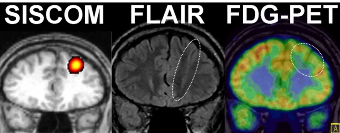 Figure 6. Convergent multimodal imaging in a patient with intractable left frontal lobe epilepsy