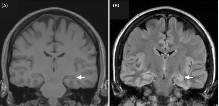 Figure 1. Left hippocampal sclerosis. The hippocampal formation is significantly smaller on the left (arrow) compared to the right  on coronal T1 (A)