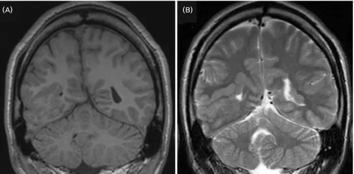 Figure 2. Malformation of cortical development in the right occipital lobe. Coronal T1 (A) shows abnormally configured cortex