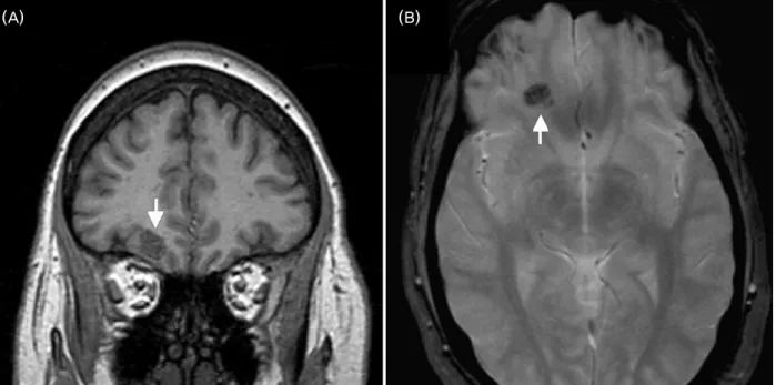 Figure 3. Cavernous angioma in the right frontal lobe. Coronal T1 shows an area of mixed signal intensity involving the  orbitofrontal cortex (arrow, A)