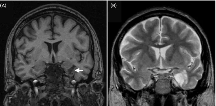 Figure 4. Dysembryoplastic neuroepithelial tumor (DNET) in the left mesial temporal lobe