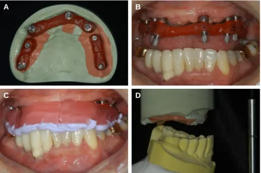 Fig. 5. Fabrication of customized titanium abutment. (A) Esthetic try-in for abutment fabrication, (B) Putty index for fabrication of abutments with proper position and angu- angu-lation, (C) Placement of the customized titanium abutment by repositioning j