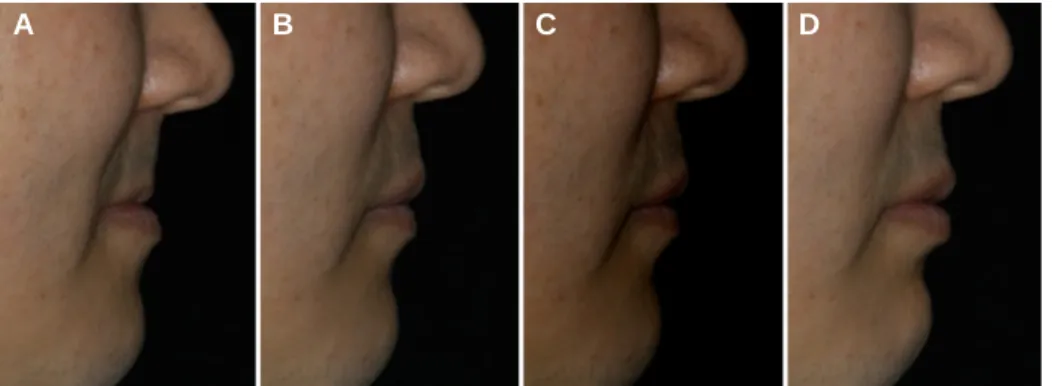 Fig. 8. Facial profile. (A) pretreatment, (B) during wearing a denture, (C) esthetic try-in, (D) post treatment.