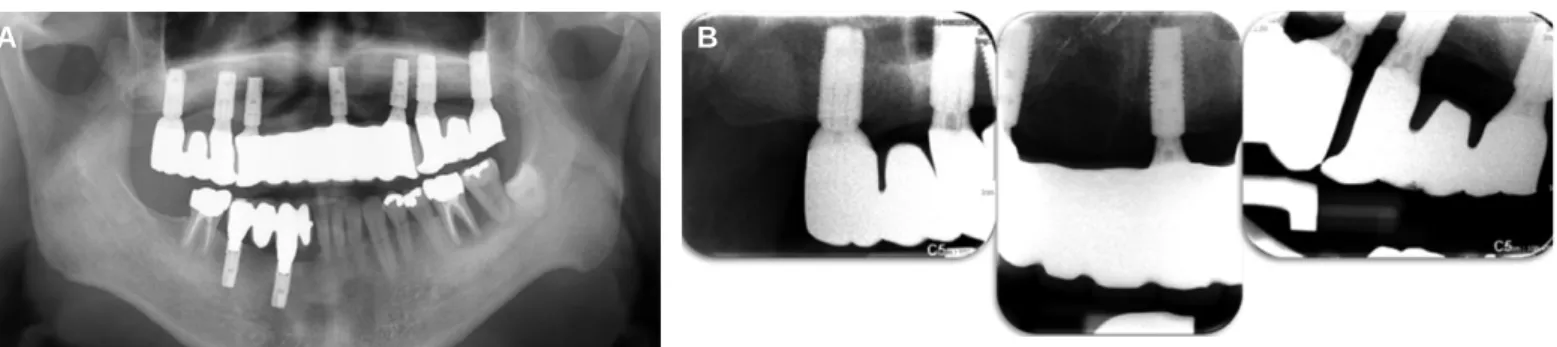 Fig. 9. (A) Post-treatment panoramic radiograph after 3 months follow-up, (B) periapical radiograhs after 9 months follow-up.