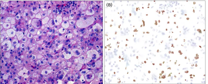 Figure 1. The histopathologic findings of axillary biopsy. (A) High-power image demonstrate the presence of numerous foamy,  lipid-laden histiocytes and Touton giant cells (hematoxylin-eosin, ×200)