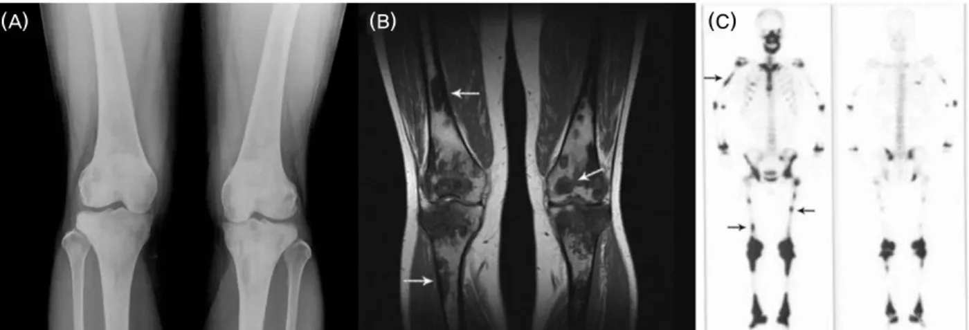 Figure 3. Radiological studies of bone. (A) A-P plain radiography of both knees show multifocal patchy areas of increased  density, coarsened trabecullae, medullary sclerosis, and cortical thickening in symmetric distribution with involvement of  diaphyses