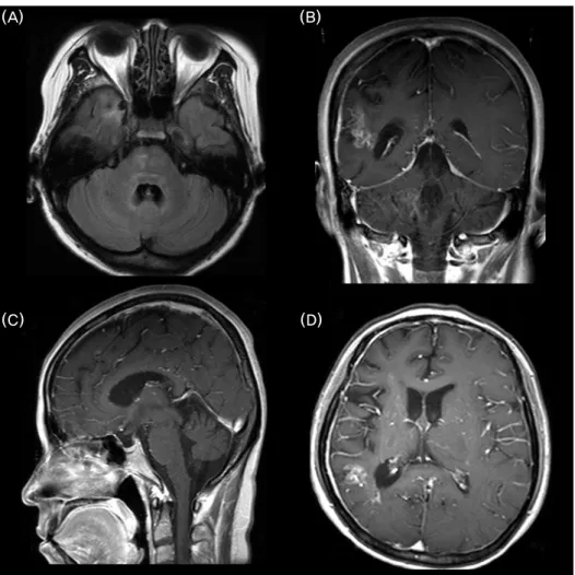 Figure 4. Brain MRI. (A) T1-weighted axial MRI shows symmetrical hyperintense signals in  the tegmentum pontis, right basis pontis, and right temporal lobe