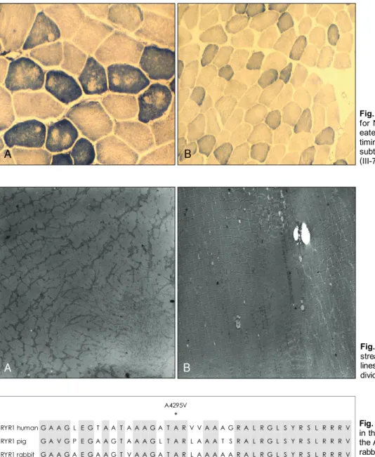 Fig. 3. Muscle biopsy sections stained  for NADH-TR with a scattered  moth-eaten appearance and unstained  mul-timinicores in the father (II-1, A) and subtle moth-eaten changes in his son (III-7, B)