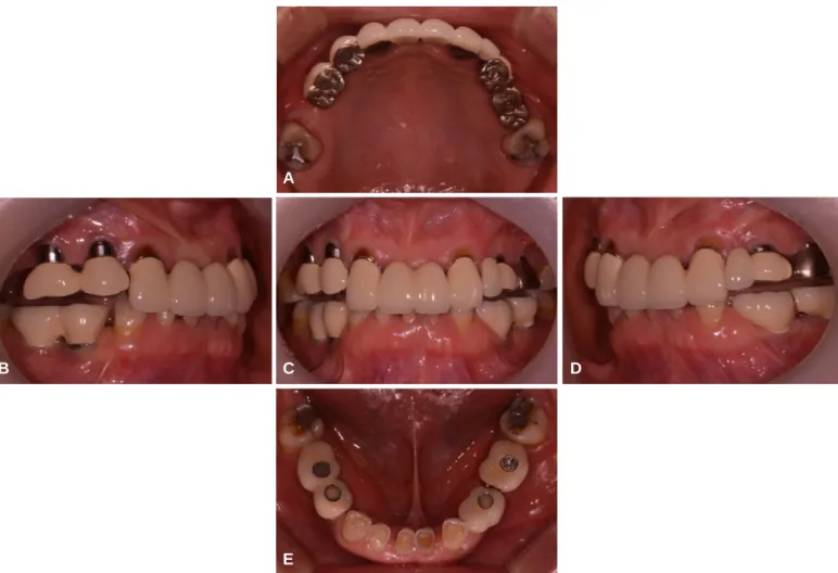 Fig. 1. Pre-operative frontal view with dento-labial disharmony.