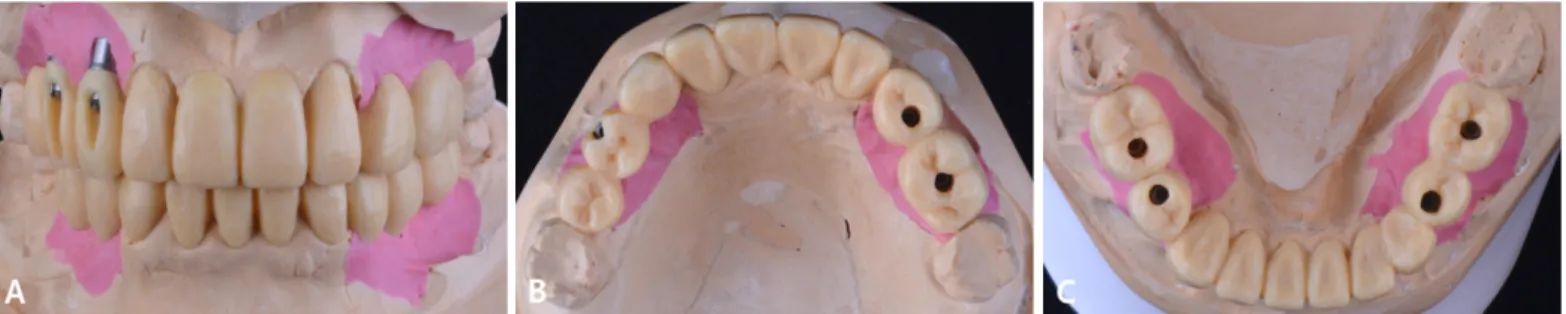 Fig. 4. Diagnostic wax-up. (A) Frontal view, (B, C) Occlusal view of maxilla and mandible.