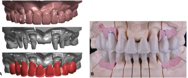 Fig. 6. CAD/CAM procedure. (A) Maxillary superimposition and cutback, (B) Frontal view of maxilla and mandible (zirconia framework).