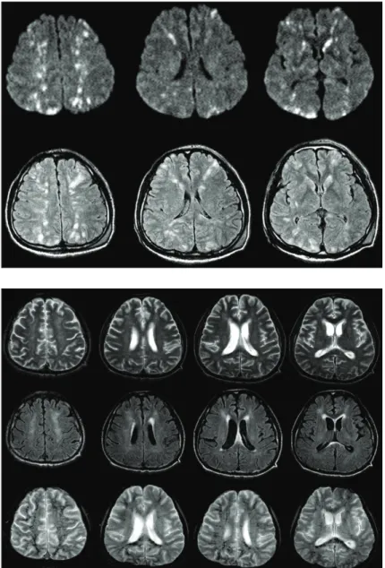 Fig. 1. Multiple scattered high signals were evident on  DWI and FLAIR images obtained 10 hours after the  on-set of drowsiness