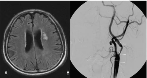 Figure 1. Images obtained in a 65-year-old man with a minor completed stroke. (A) FLAIR  image showing small ischemic lesions in the left deep white-matter area