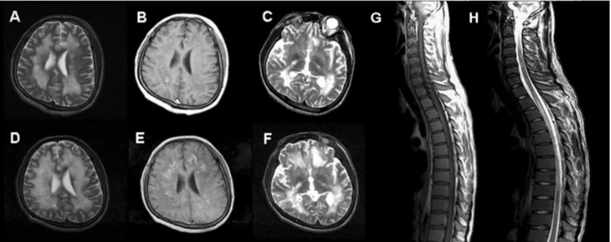 Figure 1. Cranial axial T2-weighted MRI images show multiple high-intensity signals in the periventricular  white matter and symmetric hypointensities in the thalamus (A, C), and a T1-weighted MRI image shows  multifocal calcification in the periventricula