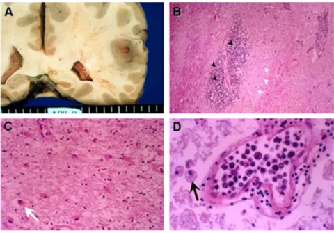 Figure 2. Coronal cross section of the brain shows diffuse gray-yellow discoloration and softening of the white  matter (A)