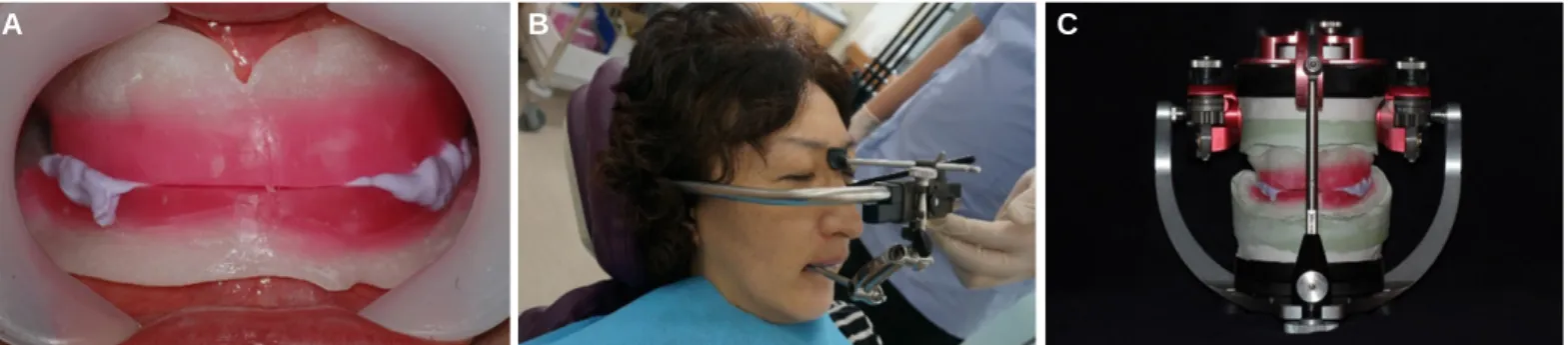 Fig. 4. CR and VD registration. (A) Frontal view, (B) Facebow transfer, (C) Master cast mounted in the articulator.