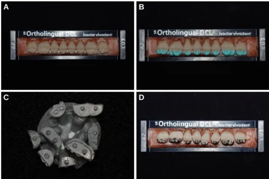 Fig. 5. Modification of artificial teeth. (A) Artificial teeth, (B) Grinding and wax up of functional cusps, (C) Casting with Ni-Cr alloy, (D) Artificial teeth with Ni-Cr alloy functional cups.
