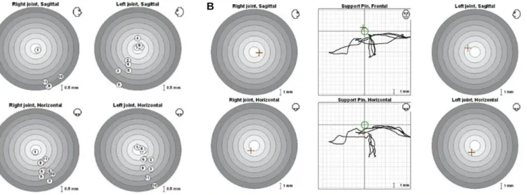 Fig. 4. Evaluation with ARCUS � digma II. (A) EPA test. ① indicates MICP. Others indicates unstable centric relation, (B) Gothic arch tracing