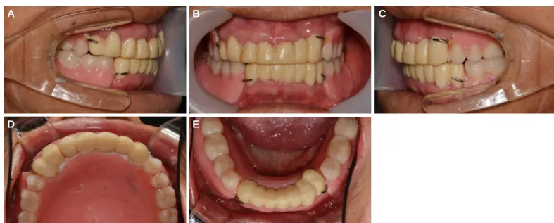 Fig. 6. Jaw relation taking with Gothic arch tracer. (A) Gothic arch tracer applied into patient mouth, (B) Repeat until taking stable and reproducible graph, (C) Confirm the ideal graph.