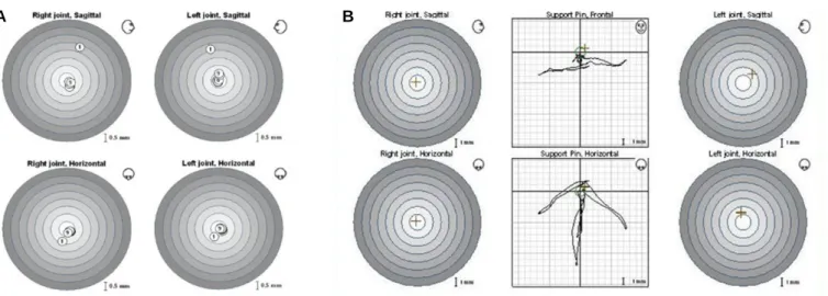 Fig. 11. CAD/CAM for surveyed PFM crowns. (A) Superimposition of wax up and die model, (B) CAD for surveyed PFM crowns, (C) Cutback on CAD for metal cop- cop-ing fabrication