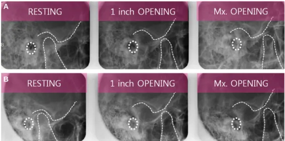 Fig. 15. Transcranial view of both TMJ after definitive denture placement. WNL on both TMJ