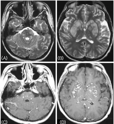 Figure 1. Brain MRI performed before treatment with steroid. 