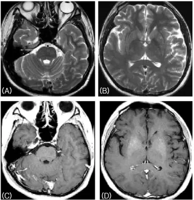 Figure 2. Brain MRI performed 2 months after treatment  with steroid. Multiple punctuate disseminated lesions were  completely resolved in T2-weighted (A, B) and gadolinium-  enhanced T1-weighted (C, D) MRI images.