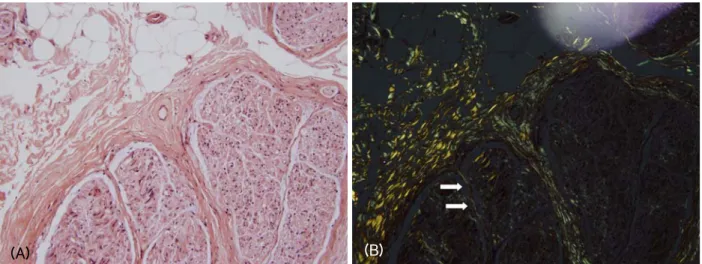 Figure 1. Deposition of amorphous materials in the endoneurium was indicated in sections stained with H&amp;E (A) that exhibited  birefringence under polarized-light microscopy with Congo red staining (B, arrows).