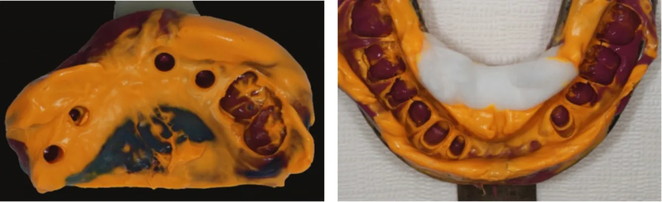 Fig. 3. Panoramic radiograph image after Implant installation.