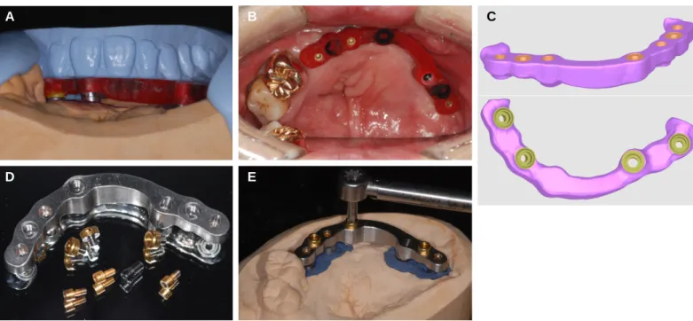 Fig. 6. (A) Titanium milled bar try-in, (B) Passive fit evaluation: direct vision and tactile sensation, (C) Passive fit evaluation: periapical radiographic image, (D) Fabricated metal framework.