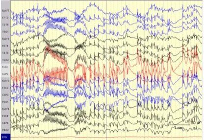 Figure 1. Example EEGs showing frequent generalized polyspike-and-wave complexes followed by  rhythmic fast waves at 15 Hz
